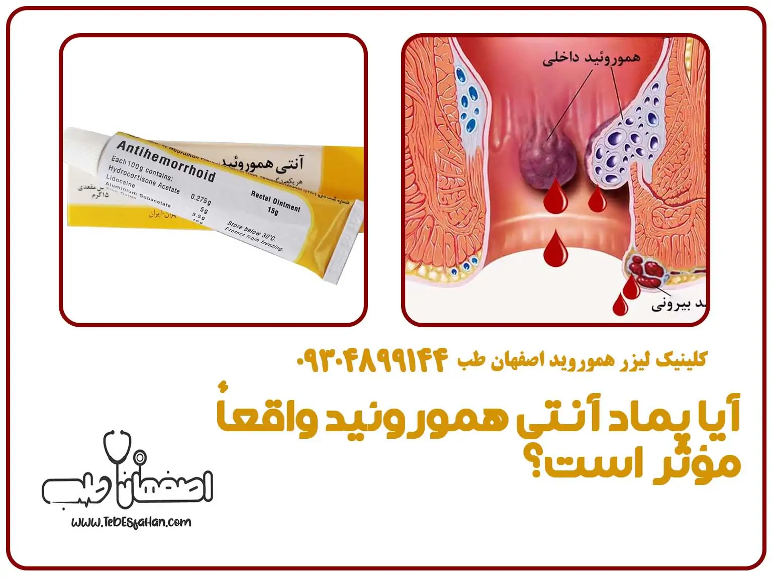 آیا پماد آنتی هموروئید واقعاً مؤثر است؟ تجربیات کاربران