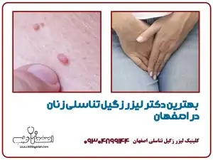 بهترین دکتر لیزر زگیل تناسلی زنان در اصفهان