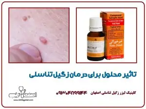 تاثیر محلول برای درمان زگیل تناسلی