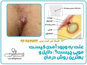 علت به وجود آمدن کیست مویی چیست؟ | دلایل و بهترین روش درمان