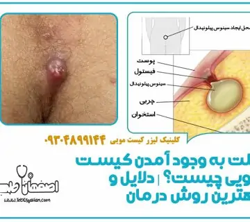 علت به وجود آمدن کیست مویی چیست؟ | دلایل و بهترین روش درمان