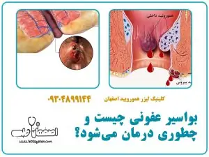 بواسیر عفونی چیست و چطوری درمان میشود؟