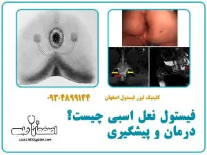 فیستول نعل اسبی چیست؟ درمان و پیشگیری- کلینیک اصفهان طب