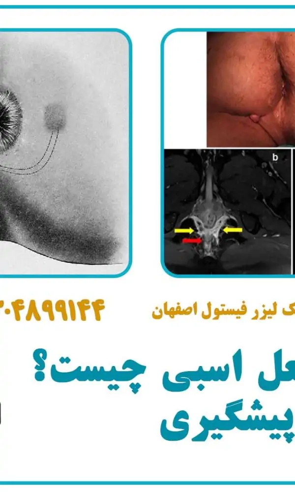 فیستول نعل اسبی چیست؟ درمان و پیشگیری- کلینیک اصفهان طب