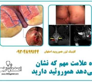 ۱۰ علامت مهم که نشان می‌دهد هموروئید دارید
