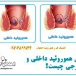 فرق هموروئید داخلی و خارجی چیست؟