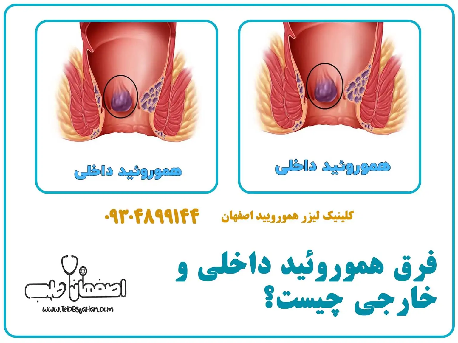 فرق هموروئید داخلی و خارجی چیست؟