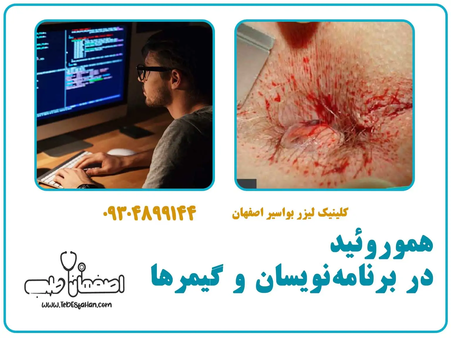 هموروئید در برنامهنویسان و گیمرها